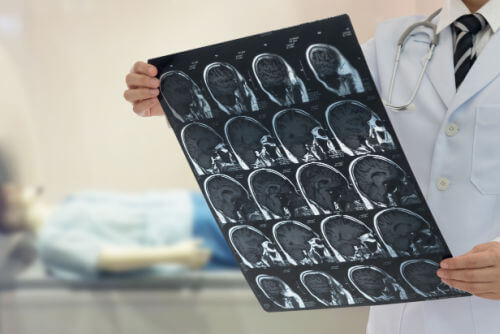 Indiana Stroke Misdiagnosis