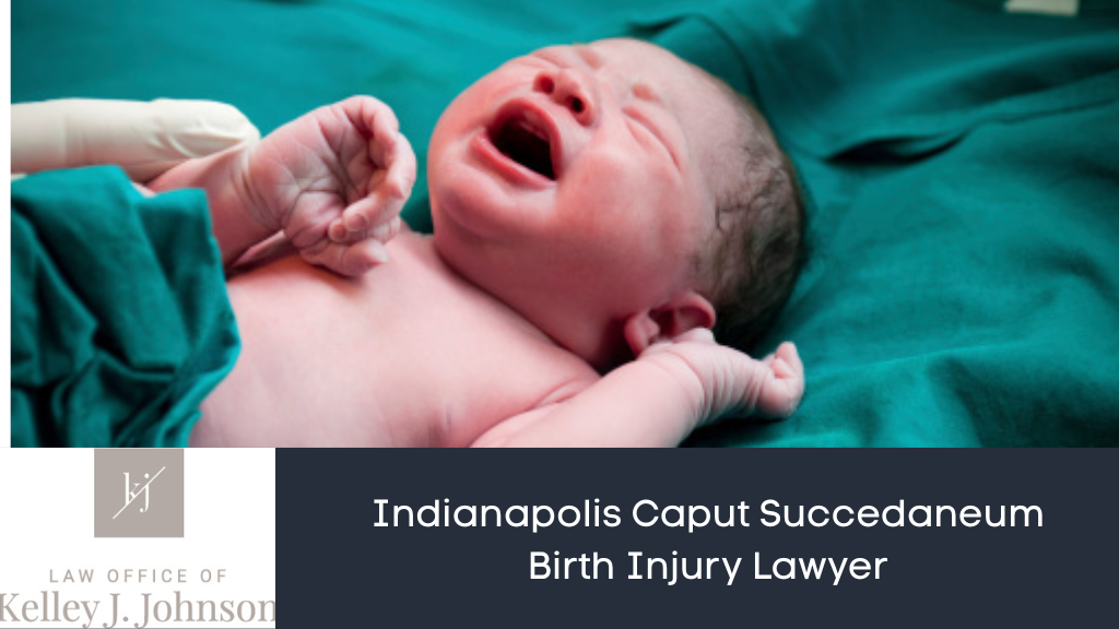 Caput Succedaneum Birth Injury